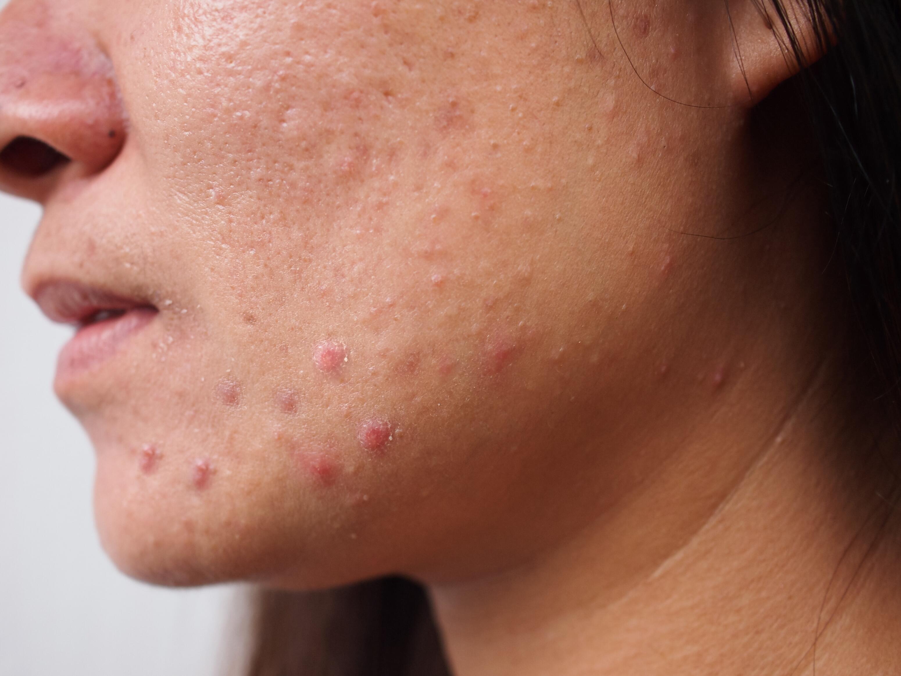 Wat is hormonale acne